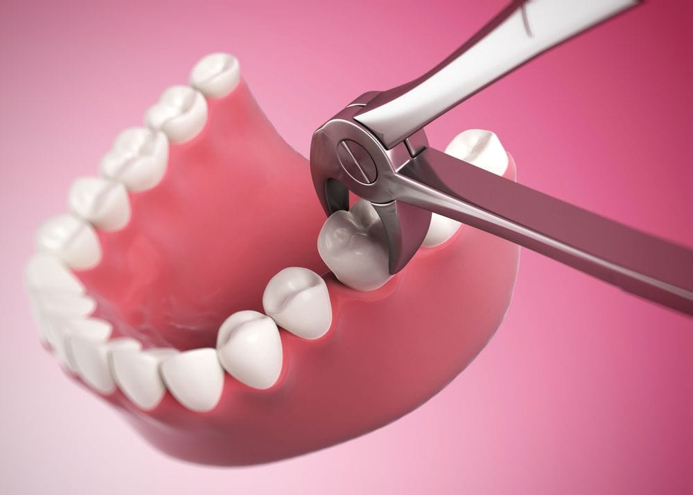 Tooth extraction and oral consultation at Nitro Dentists clinic inside Kakatkar Hospital Nashik