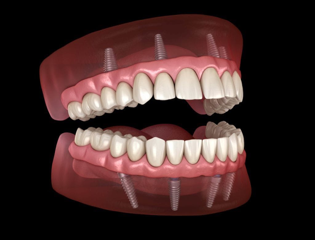 Full Mouth Rehabilitation