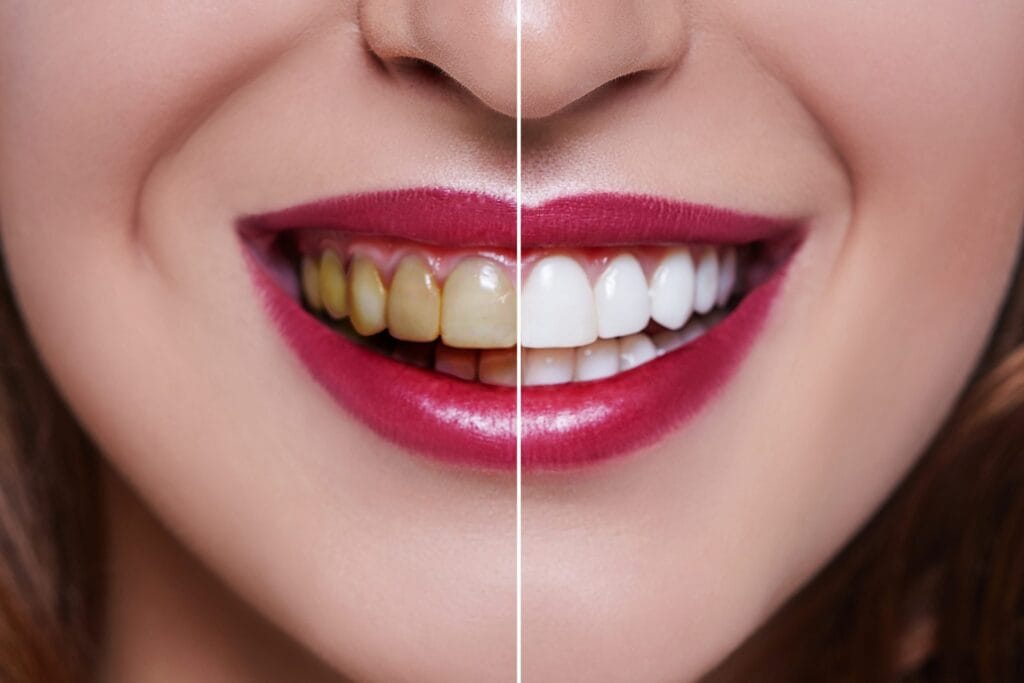 Brighten Your Smile and Boost Your Confidence with Expert Teeth Whitening