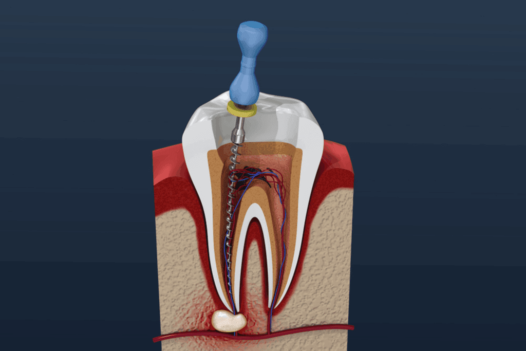 Root Canals