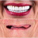 Full Mouth Rehabilitation